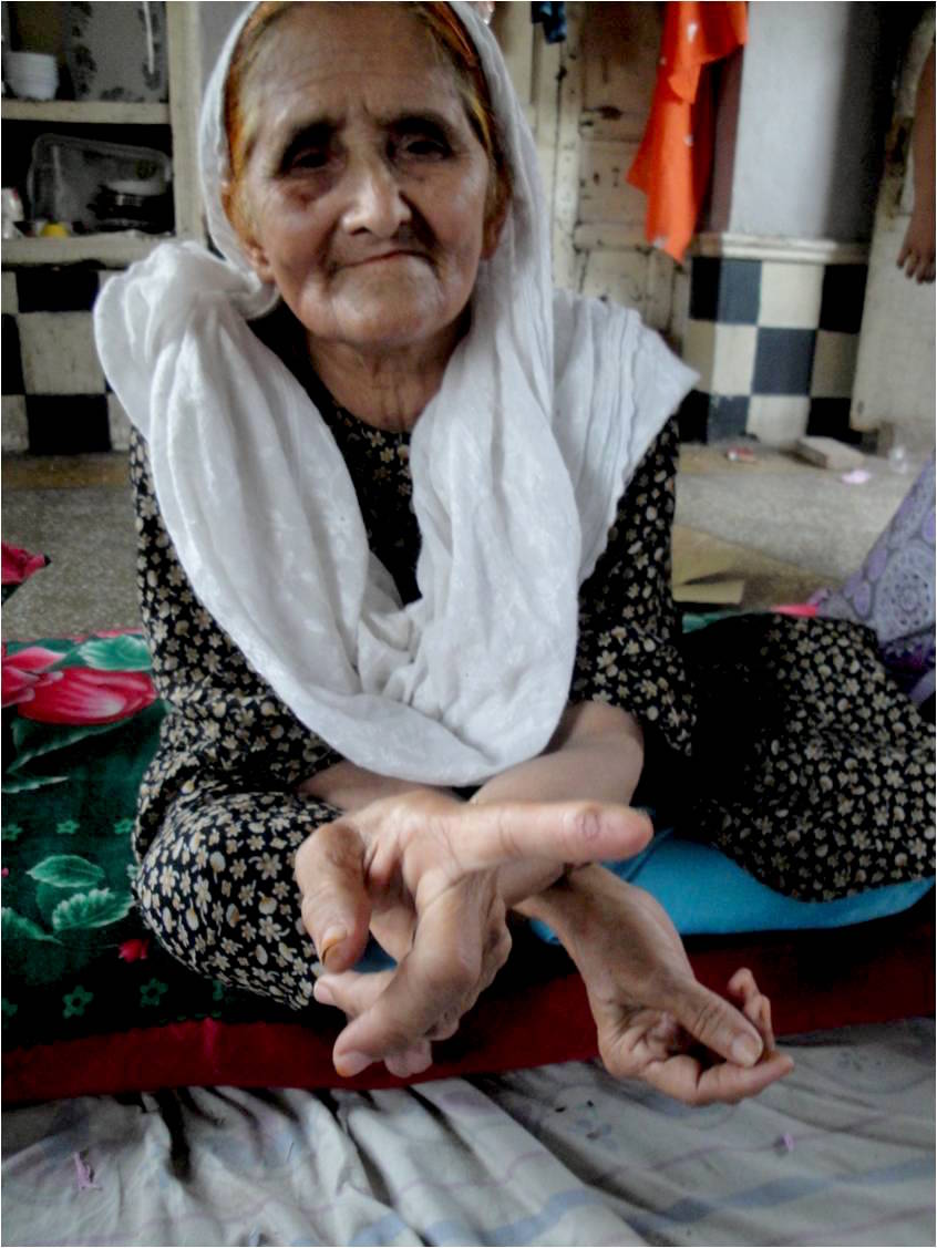 Shaari woman showing her blister from shelling pine nuts.